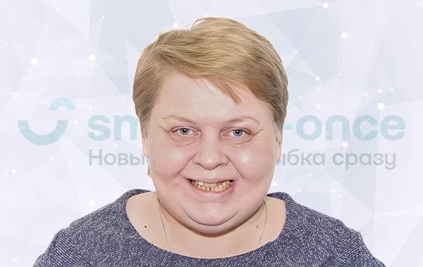 Имплантация всех зубов all-on-6 Nobel Biocare до