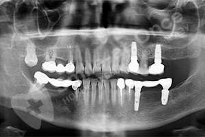 Замена зубного моста на импланты