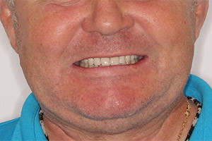Применение технологии Basal Complex для верхней челюсти