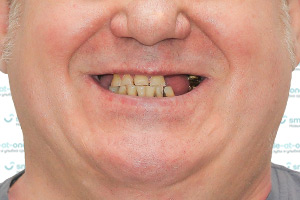 Straumann Pro Arch – все зубы за 1 день ДО