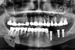 Замена зубного моста имплантатами