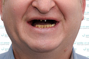 Зубы за 1 день All-on-4 и постоянный протез ДО