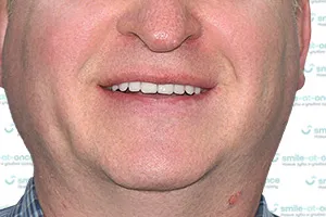 Зубы за 1 день All-on-4 и постоянный протез ПОСЛЕ