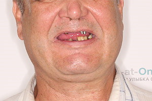 Комплексная базальная имплантация 2 челюсти