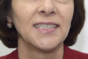 Протокол All-on-4 для восстановления нижней челюсти