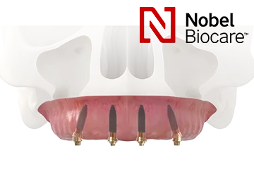 ALL-ON-4 - Все зубы на четырех имплантах