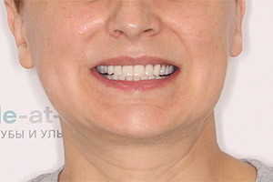 Воссстановление разрушенных зубов - однофазная имплантация