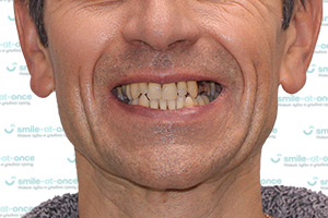 Все зубы за 1 день с All-on-6 и установка постоянных протезов ДО