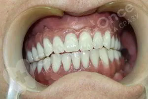 После имплантации всех зубов