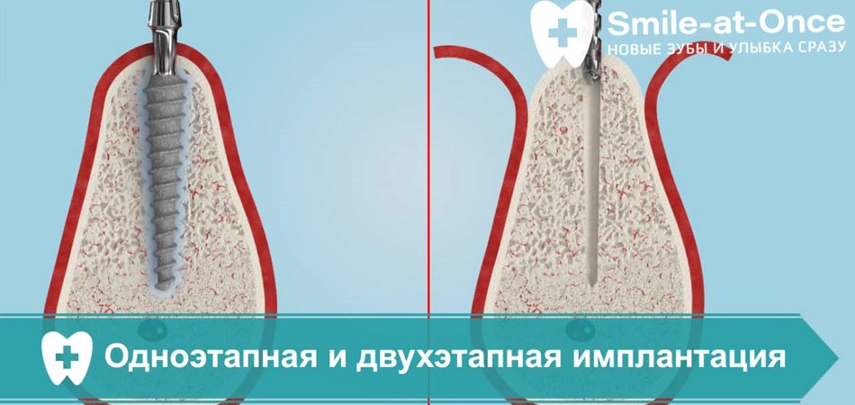 Видео об одноэтапной и двухэтапной имплантации - сравнение