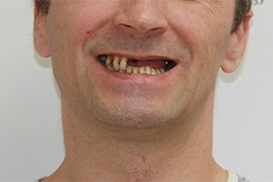 Однофазная имплантация верхней челюсти с протезом из керамокомпозита