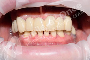 Имплантация верхней челюсти и жевательных зубов
