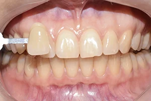 Бережное отбеливание эмали зубов ДО