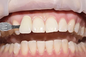 Бережное отбеливание эмали зубов ПОСЛЕ