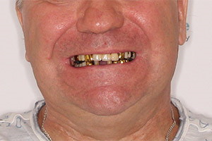 Замена зубных мостов нижней челюсти
