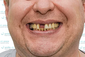 Обновление улыбки при помощи имплантации ДО
