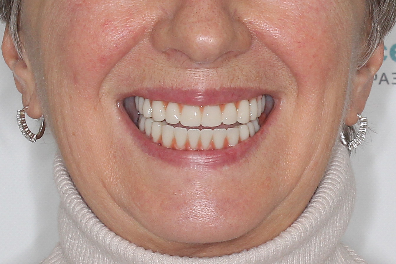 Новые зубы за 3 дня. Basal Complex на обе челюсти, фото после