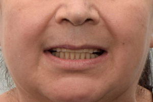 Перепротезирование после имплантации всех зубов, фото до