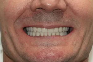 Постоянное протезирование после комплексной имплантации зубов, фото до