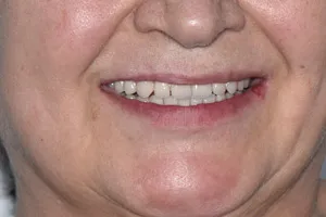 Перепротезирование после имплантации всех зубов, фото после