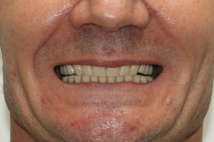 Постоянное протезирование после комплексной имплантации зубов, фото после