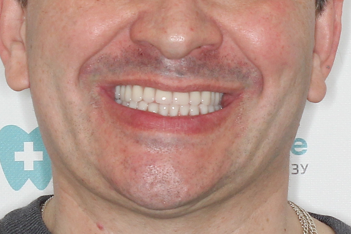 Basal Complex на обе челюсти и керамокомпозитные протезы через год, фото до 