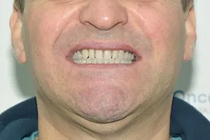 Имплантация ALL-ON-3 – Trefoil на нижней челюсти