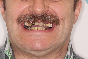 Однофазная имплантация двух челюстей
