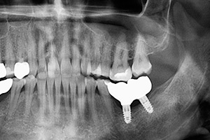 Имплантация переднего зуба ДО