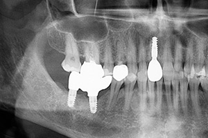 Имплантация переднего зуба ПОСЛЕ