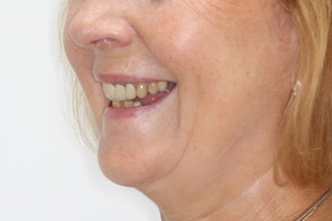 Базальная имплантация для верхней челюсти и All-on-4 для нижней