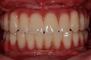 Профессиональная гигиена через год после тотального восстановления зубов на обеих челюстях
