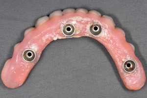Плановая гигиена после восстановления зубов на имплантах