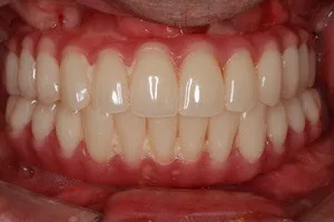 Плановая гигиена через 6 месяцев после имплантации зубов, фото до