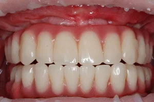 Профессиональная гигиена через год после тотального восстановления зубов на обеих челюстях, фото после