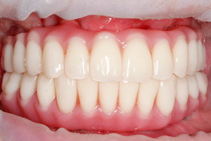 Плановая гигиена через 6 месяцев после имплантации зубов, фото после