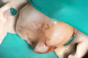 Реставрация жевательного зуба