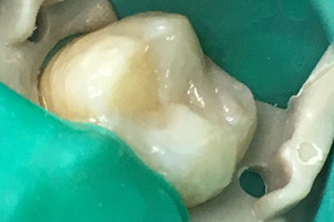Реставрация жевательного зуба, фото после