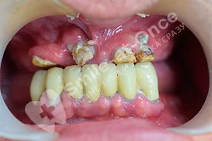 Протезирование зубов методом All on 6