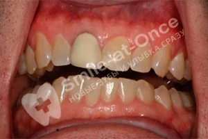 Восстановление зубов коронками и винирами