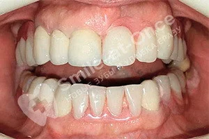 Установка съемных зубных протезов