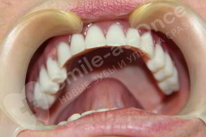 После протезирования зубов методом All-ON-6