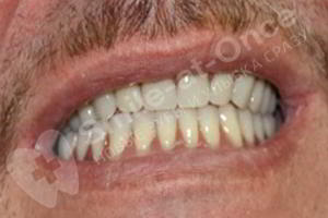 Протезирование зубов All-ON-6 - фото после