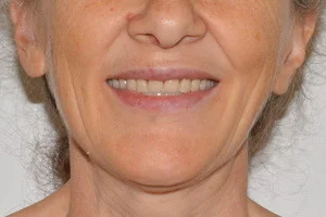 Съемные протезы на обе челюсти, фото после