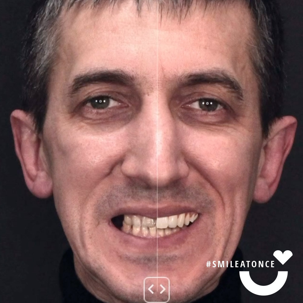 Цифровой дизайн улыбки