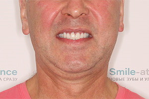 Восстановление всех зубов пациента