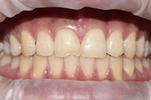 Реставрация переднего зуба ДО