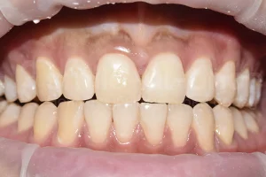 Реставрация переднего зуба ПОСЛЕ