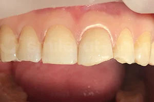 Реставрация зубов ДО