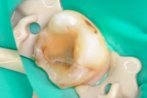 Реставрация жевательного зуба после лечения пульпита, фото до